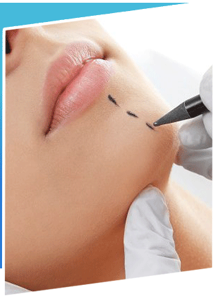 Chin Implant Surgery in Iran