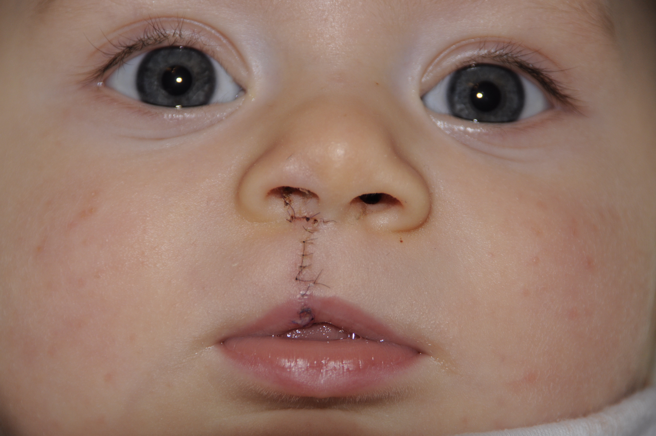 Cleft Lip and Cleft Palate Treatment in Iran