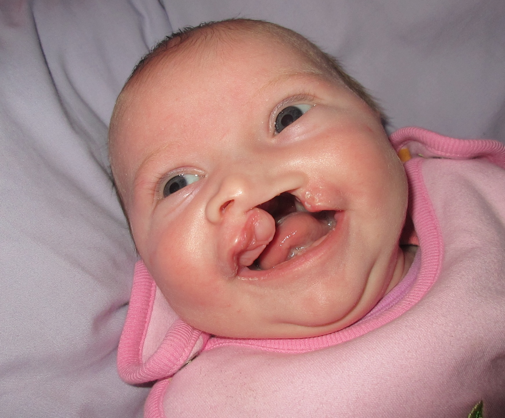 Cleft Lip and Cleft Palate Treatment in Iran 