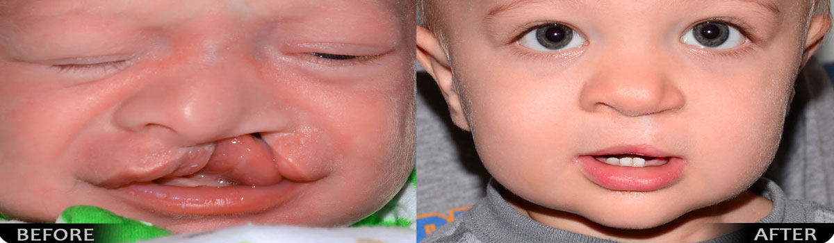 Cleft Lip and Cleft Palate Treatment in Iran