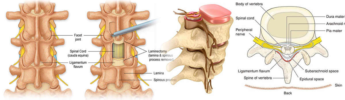 Spinal Laminectomy in Iran