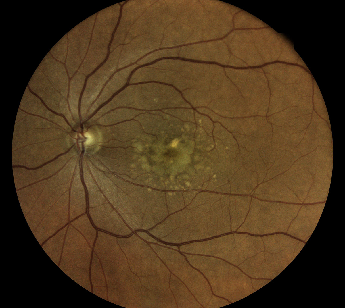 Age-Related Macular Degeneration in Iran