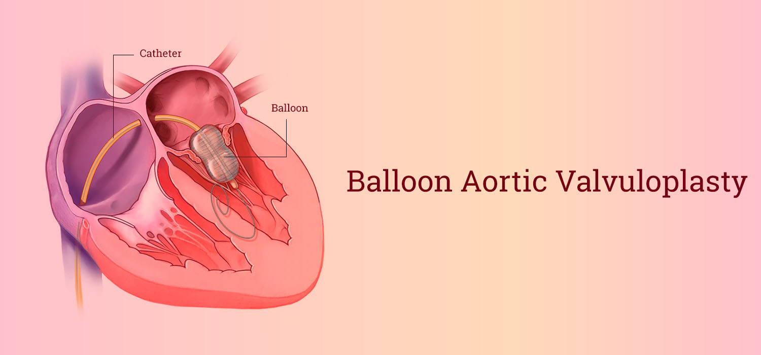 Balloon Aortic Valvuloplasty in Iran