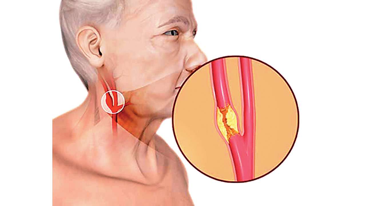 Carotid Artery Disease in Iran