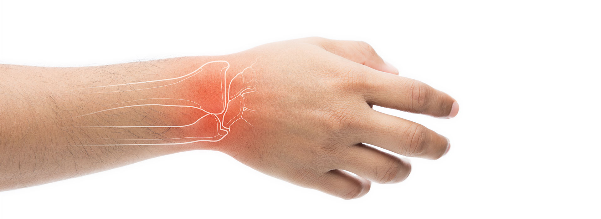 Carpal Tunnel Syndrome Treatment in Iran