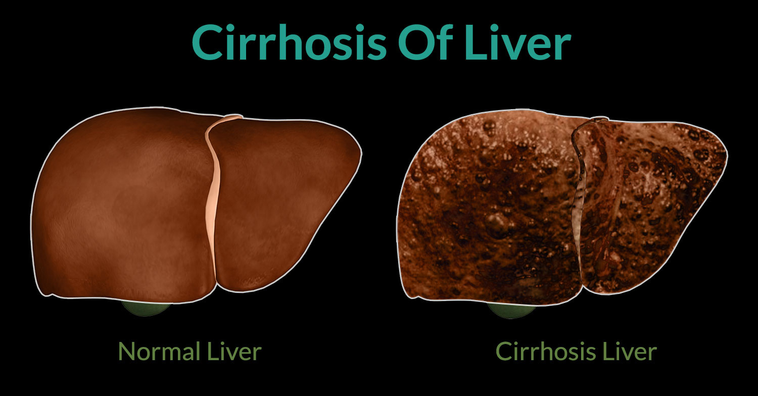 Cirrhosis of Liver Treatment in Iran 2