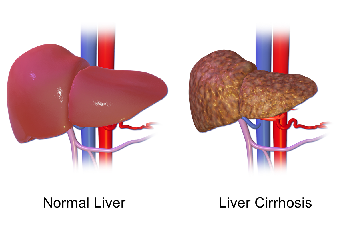 Cirrhosis of Liver Treatment in Iran