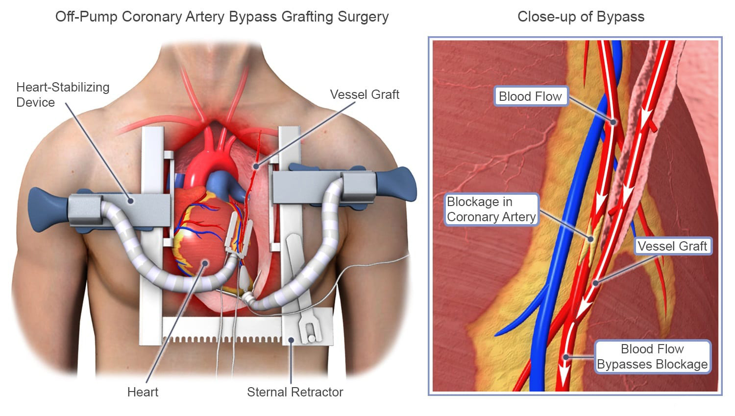 Coronary Artery Bypass Surgery in Iran