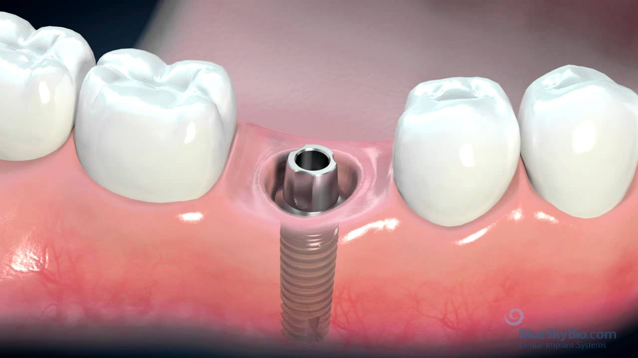 Dental Implant in Iran 