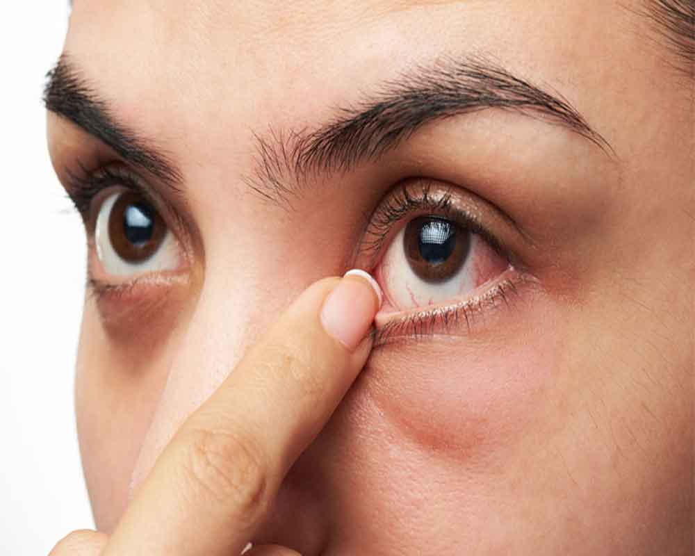Dry Eye Treatment in Iran