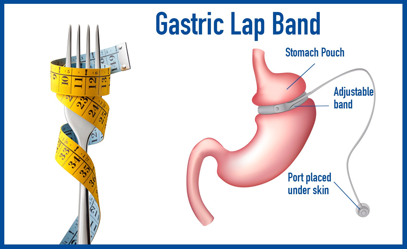 Gastric Banding (Lap Band Surgery) in Iran