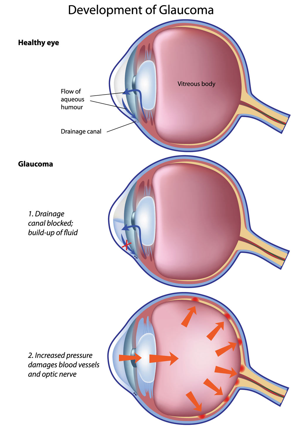 Glaucoma Treatment in Iran