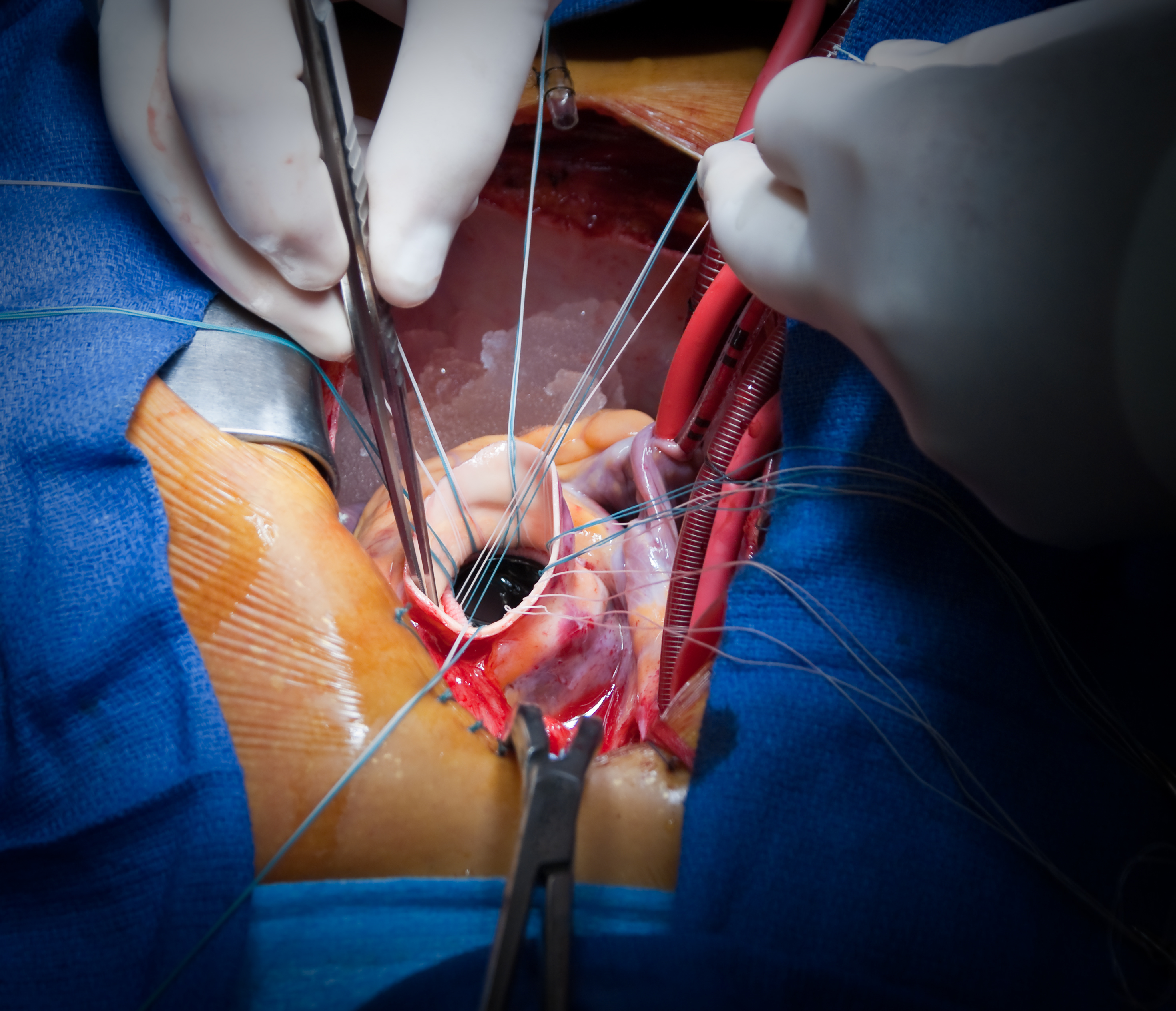Heart Valve Replacement Surgery in Iran