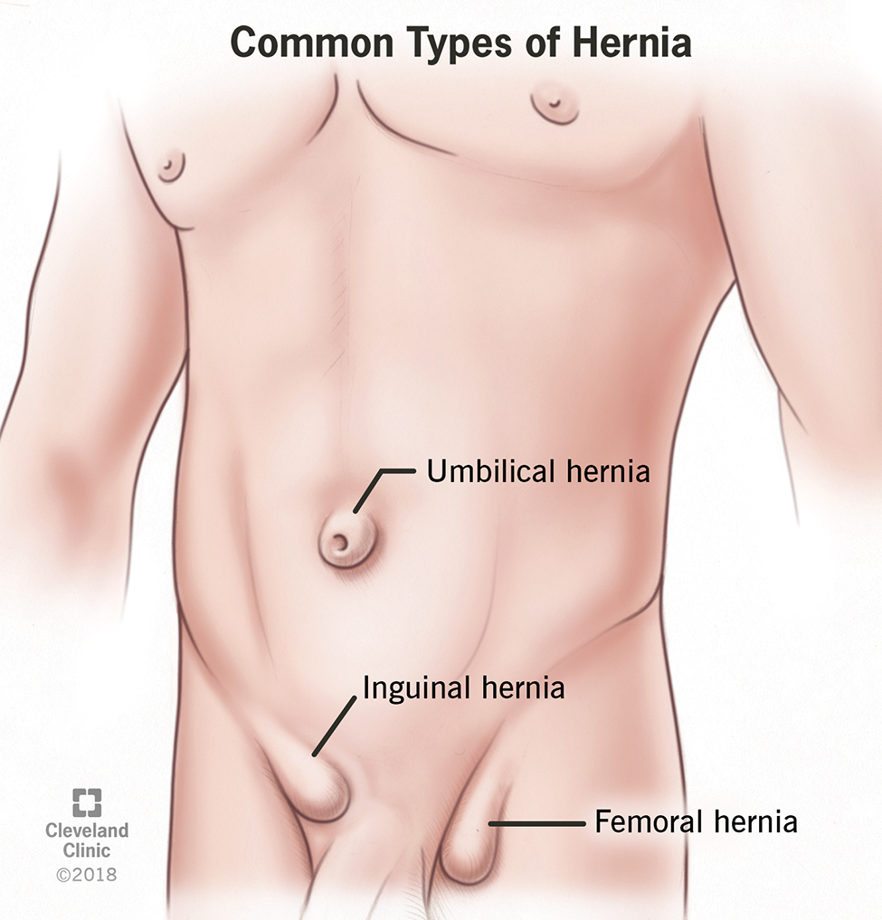 Hernia Treatment in Iran