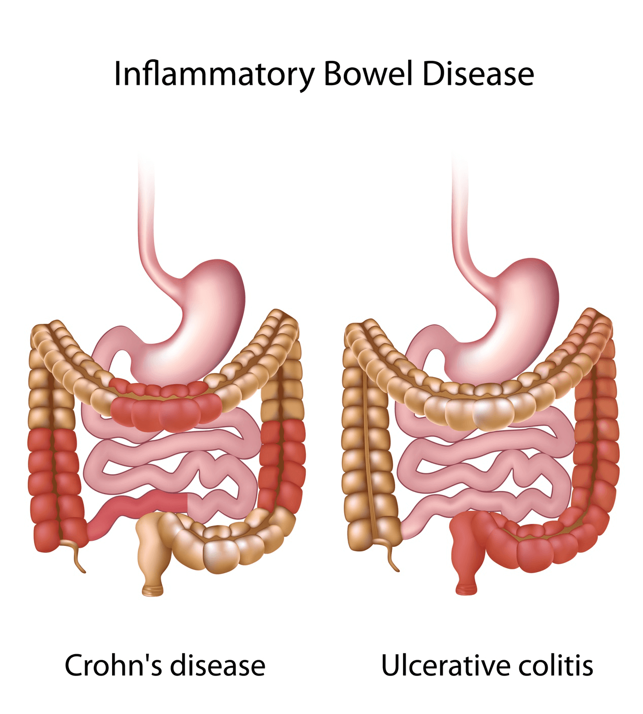 Inflammatory Bowel (Crohn's) Disease Treatment in Iran