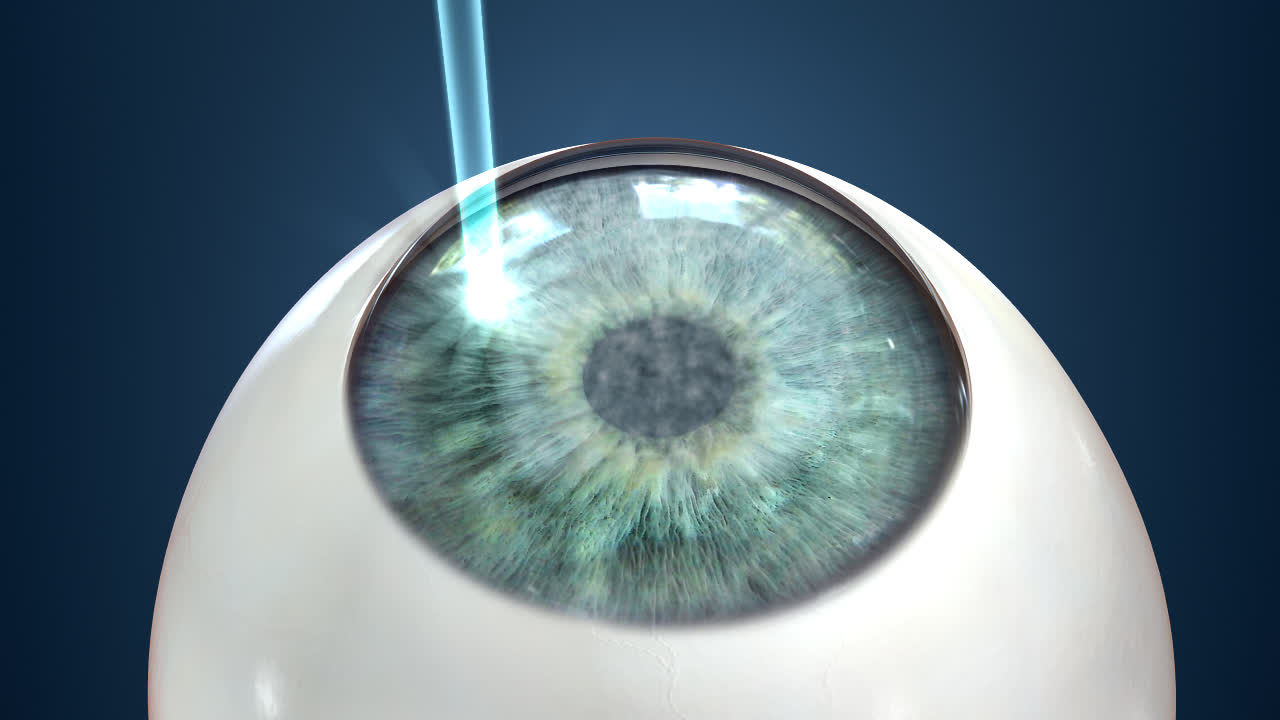 LASIK Laser Eye Surgery in Iran