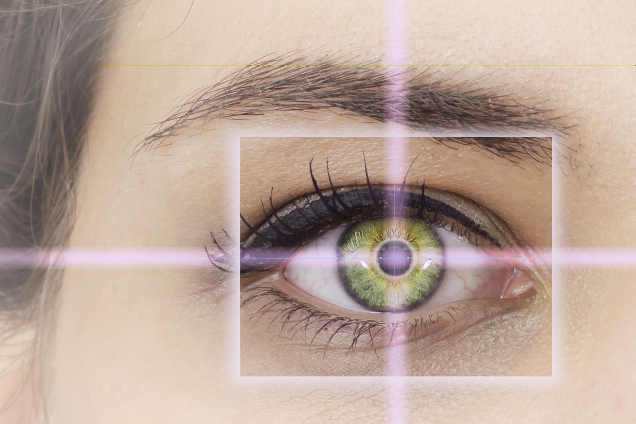 LASIK Laser Eye Surgery in Iran