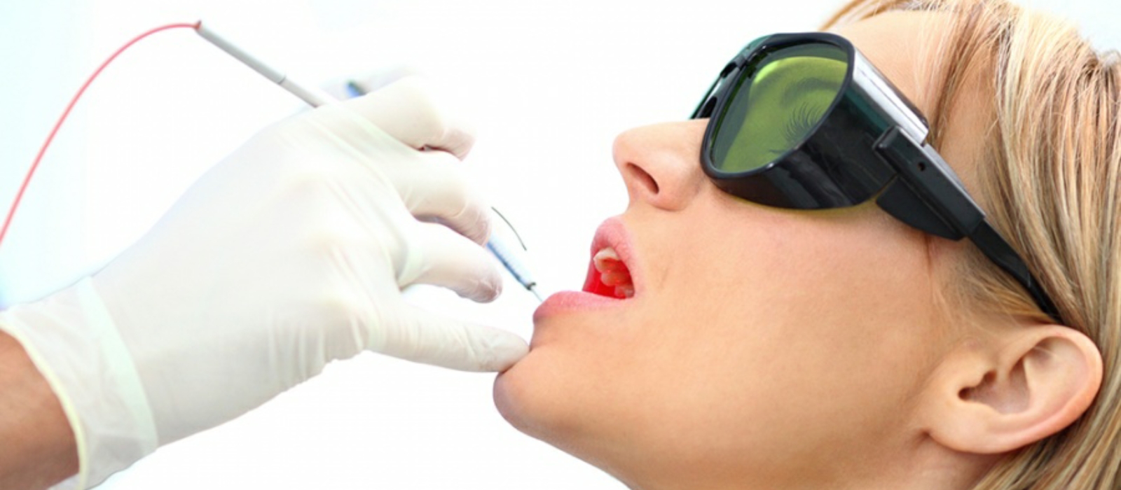 Laser Dental Treatments in Iran
