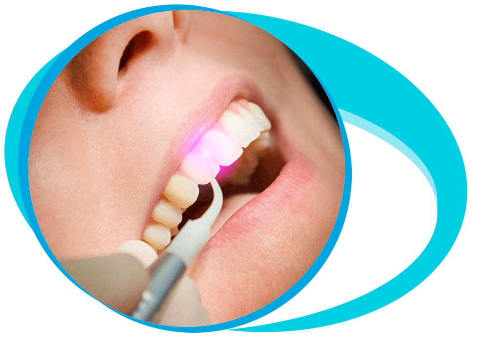Laser Dental Treatments in Iran