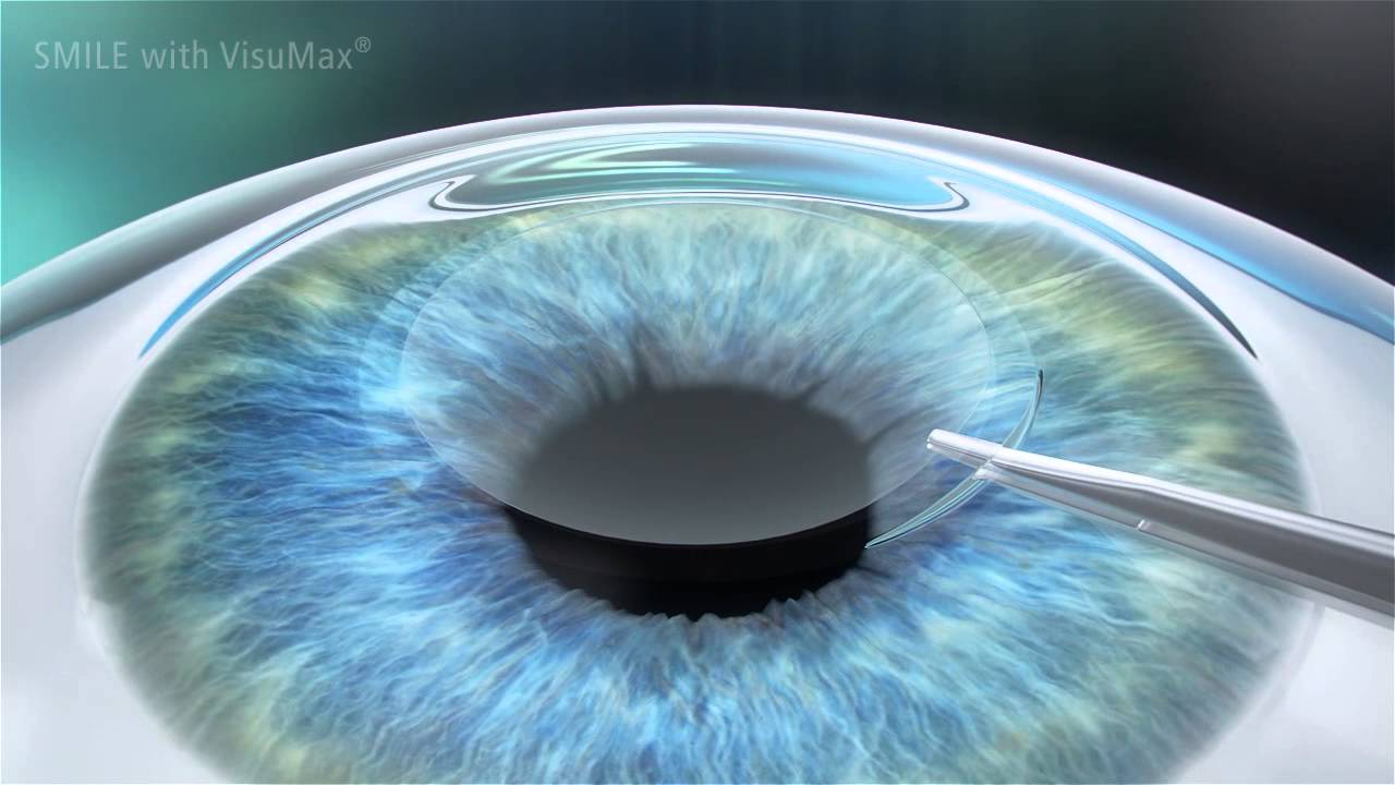 Laser Eye Surgery in Iran