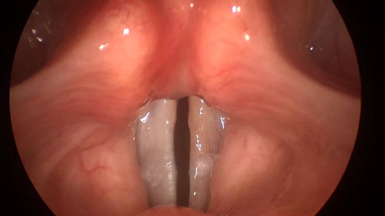 Laser Vocal Cord Surgery in Iran