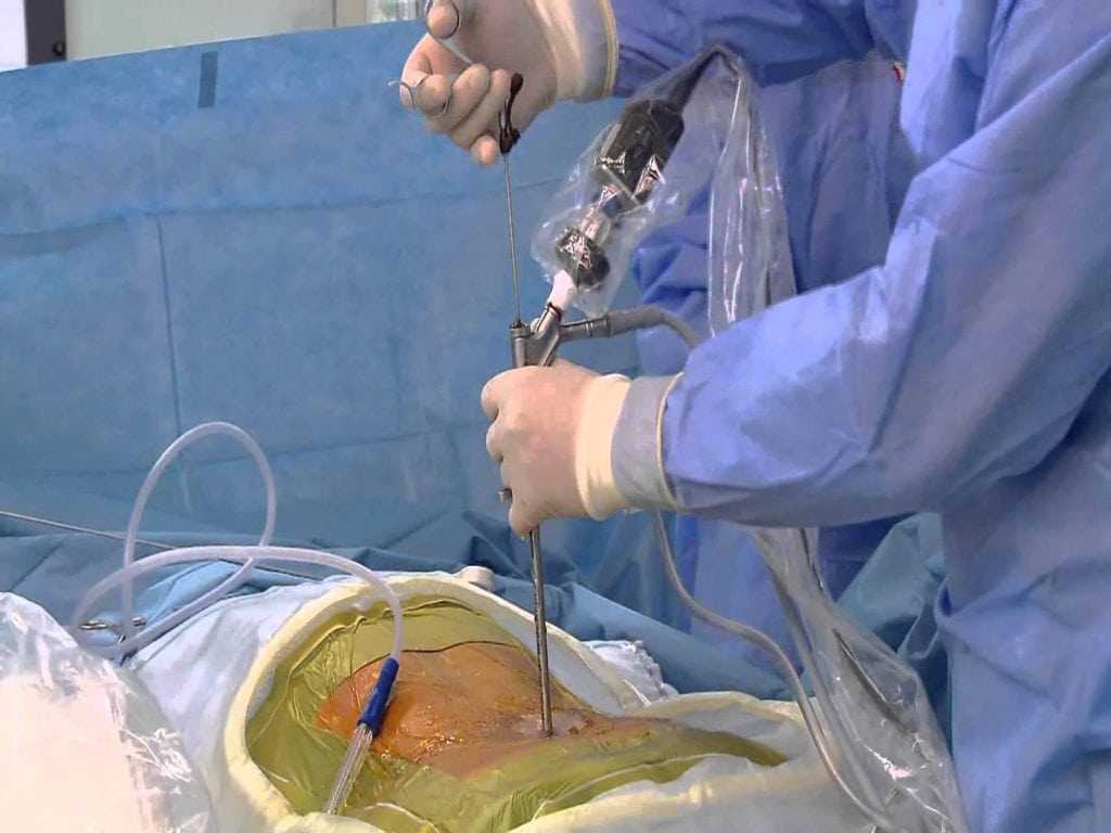 Lumbar Discectomy in Iran
