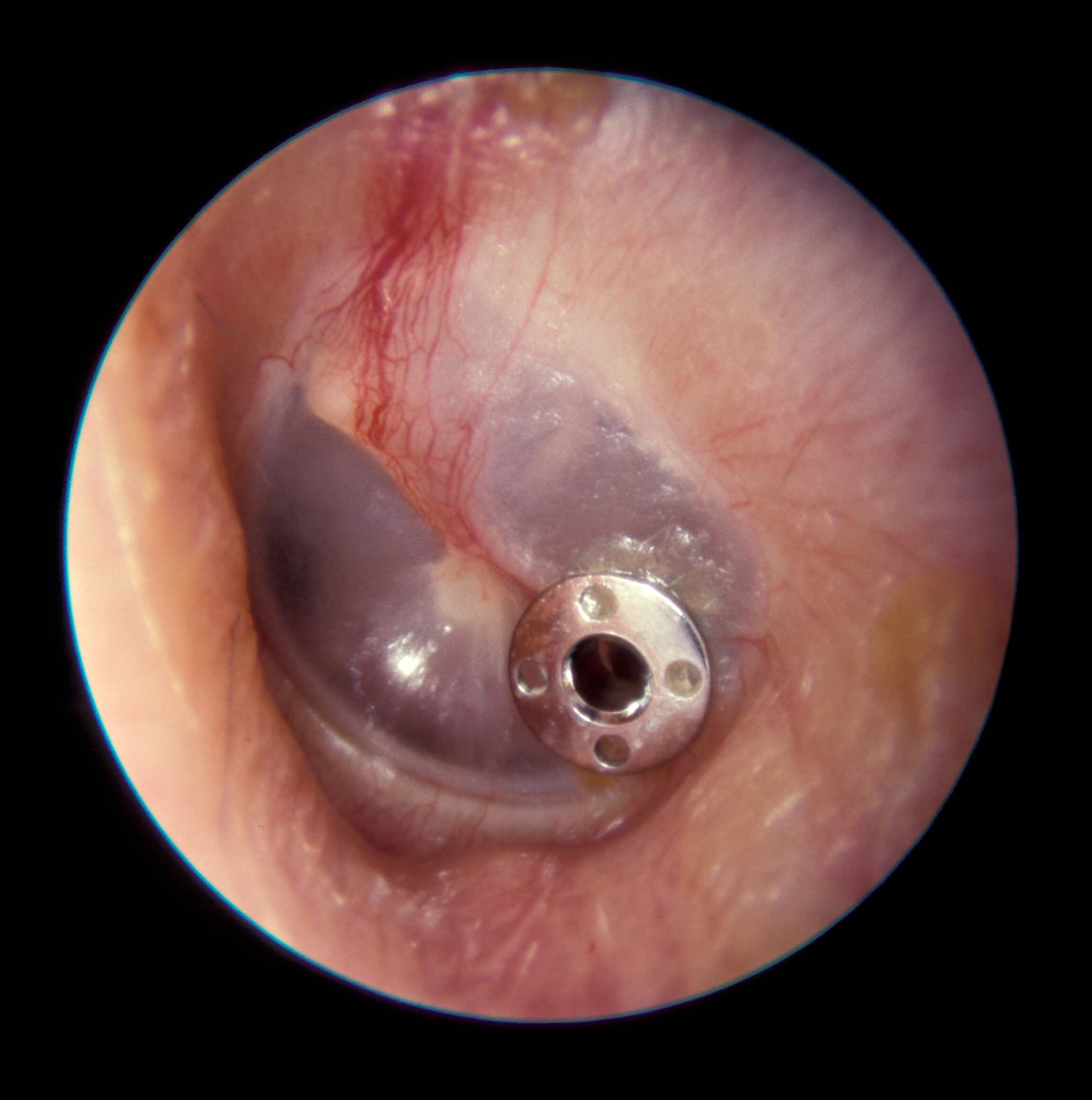 Myringotomy (Ear Surgery) in Iran