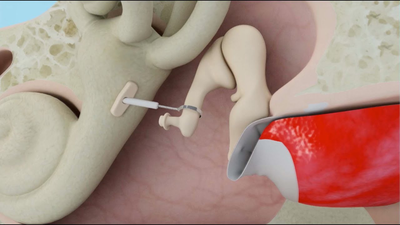 Ossiculoplasty (Middle Ear) Surgery in Iran