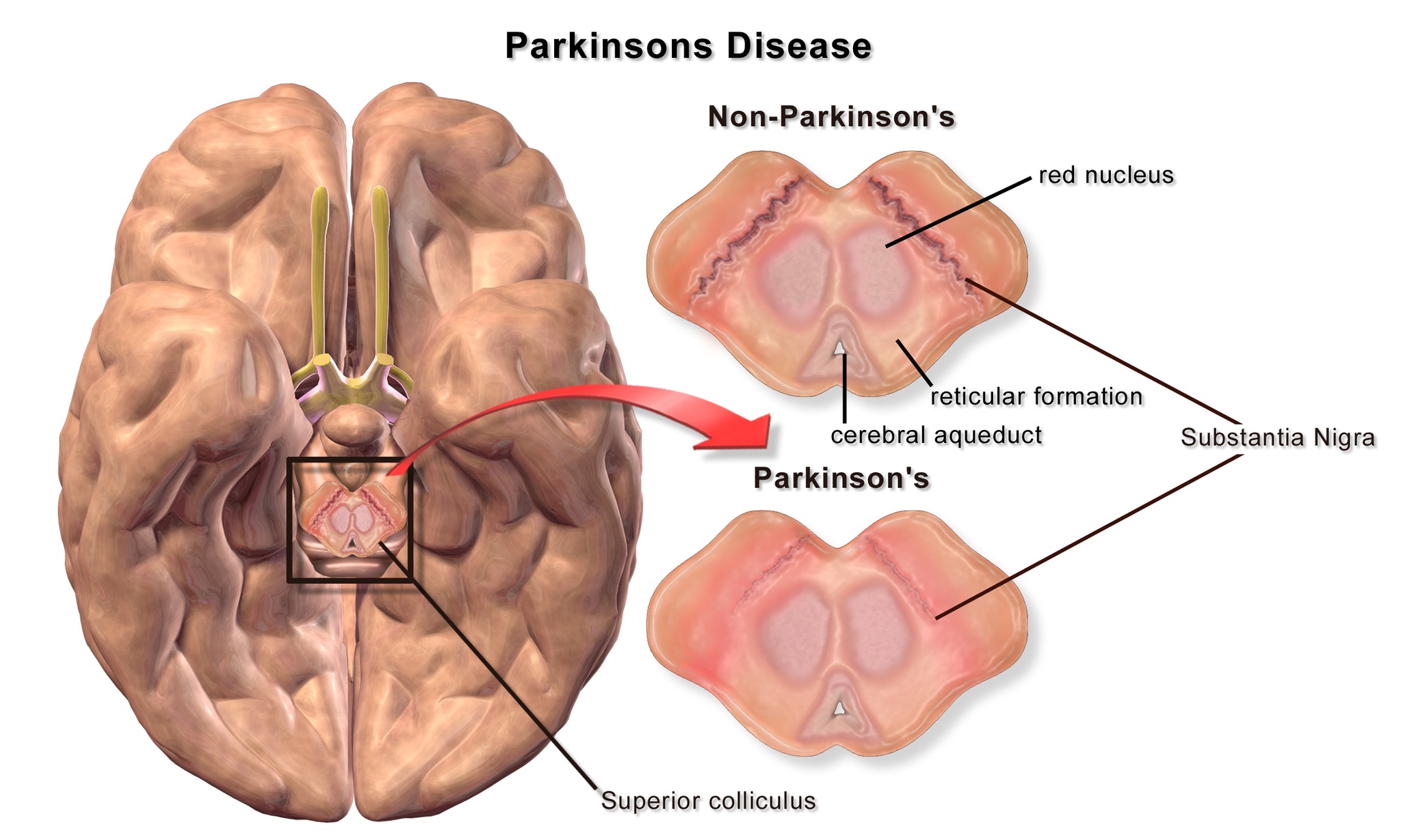 Parkinsons Disease Treatment in Iran