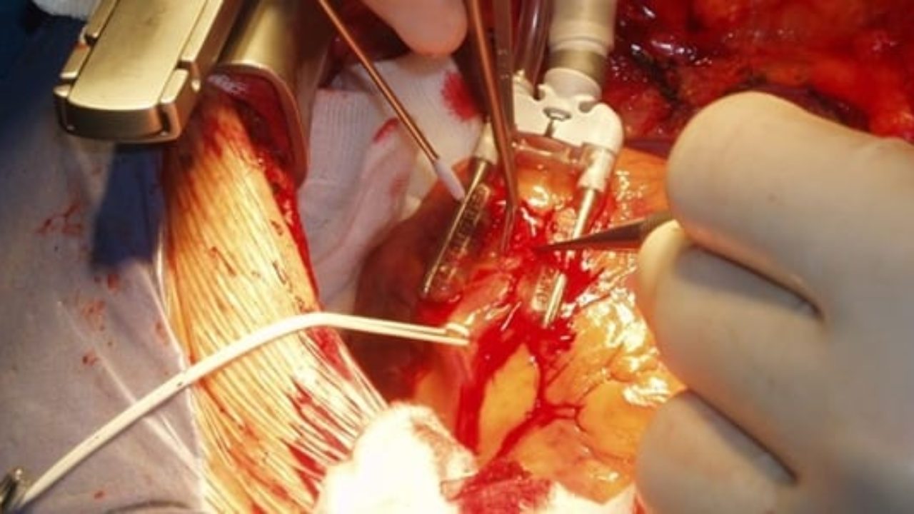 Pediatric Cardiac Surgery in Iran