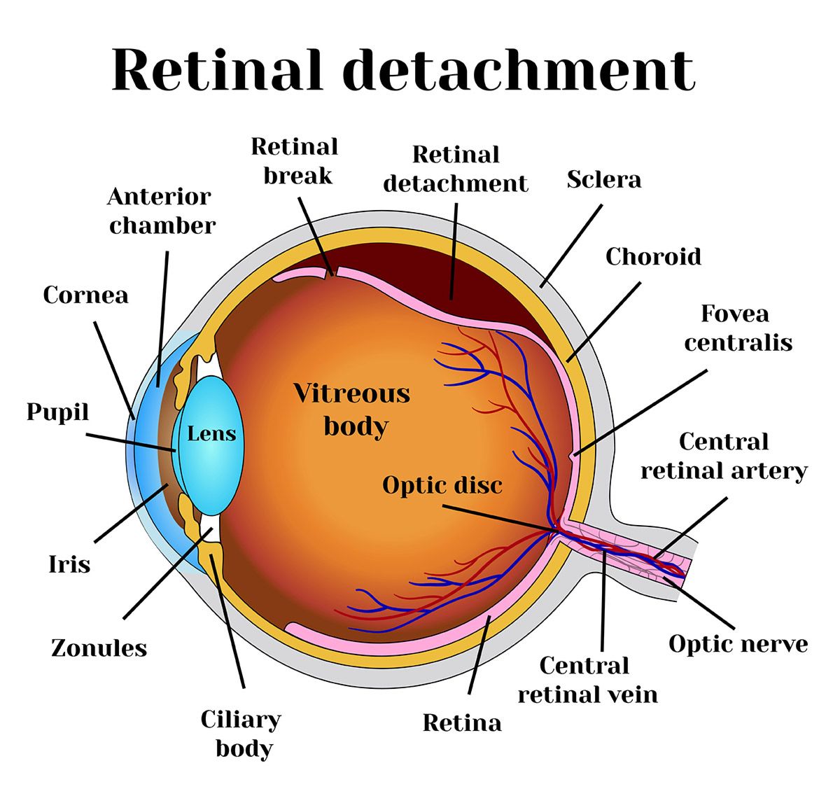 Retinal Detachment in Iran