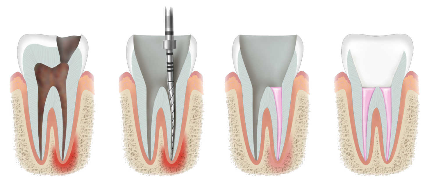 Root Canal Treatment in Iran