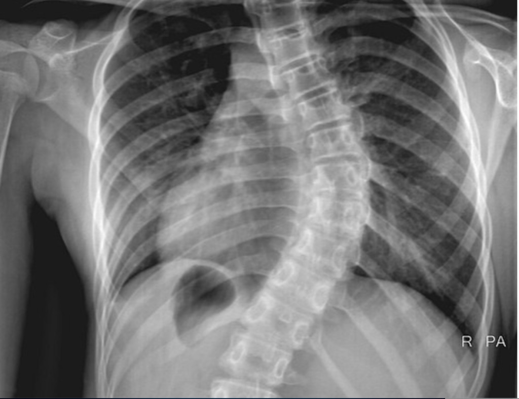 Spinal Fusion in Iran
