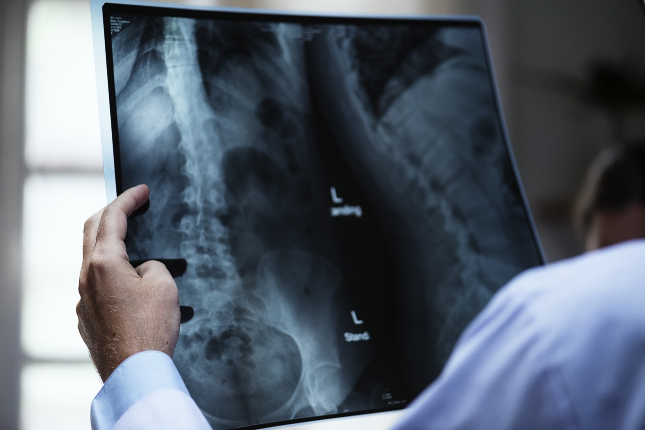 Spinal Fusion in Iran