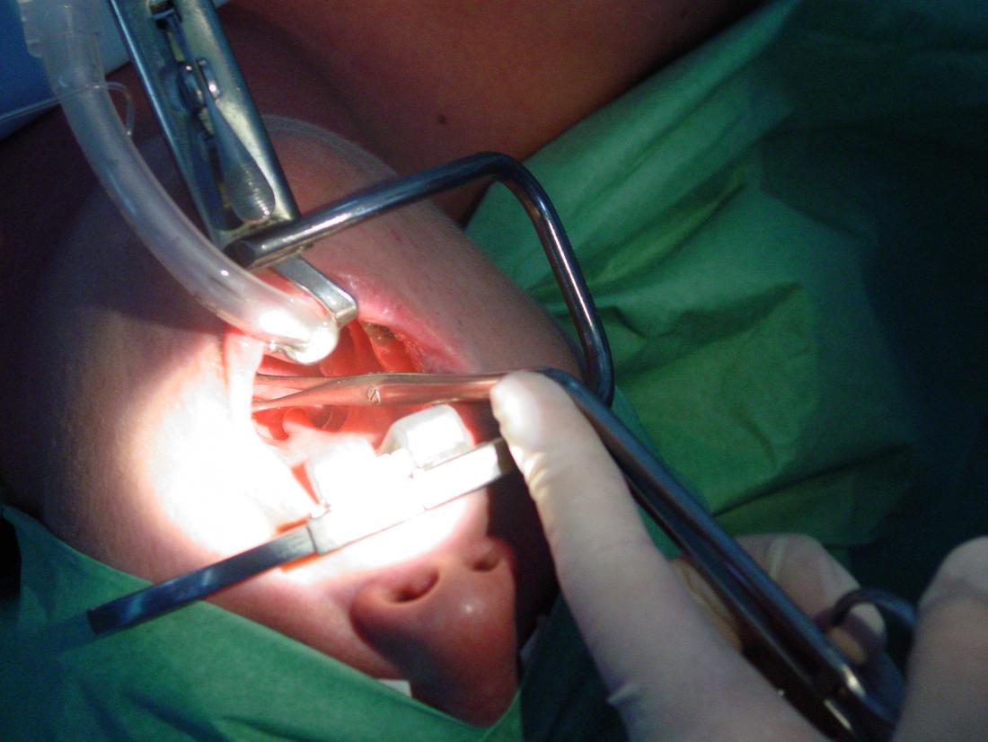 Tonsil Surgery in Iran