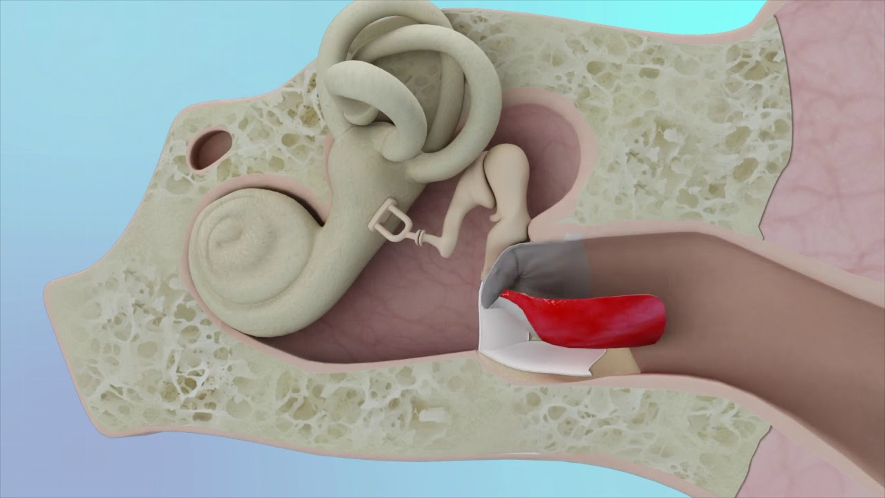 Tympanoplasty (Hole in Ear Drum) Surgery