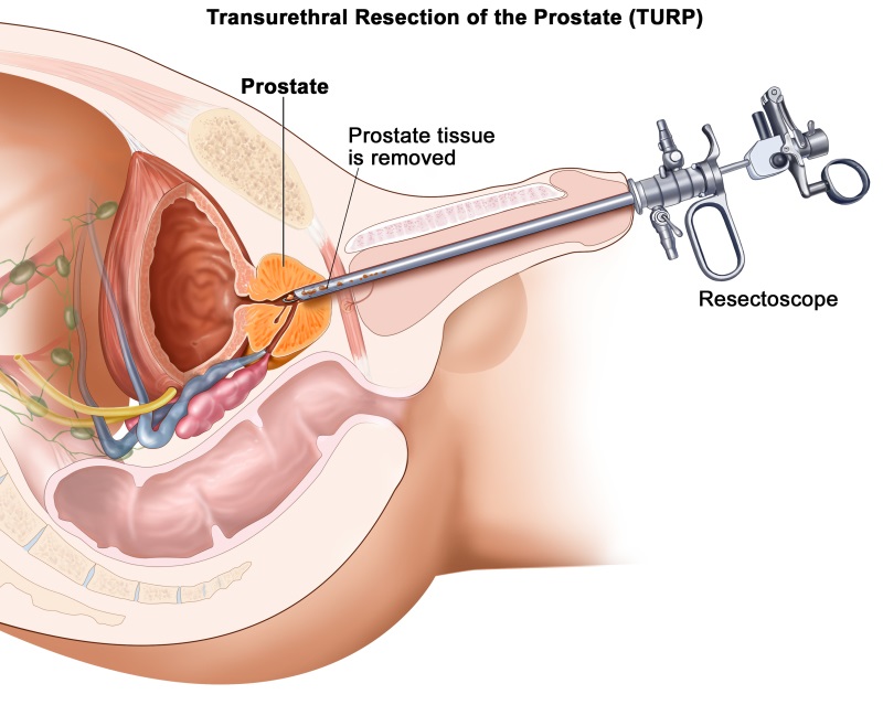 Transurethral resection of the prostate (TURP) in Iran