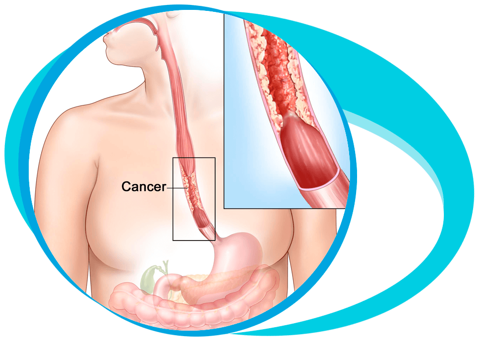Esophageal Cancer Treatment in Iran