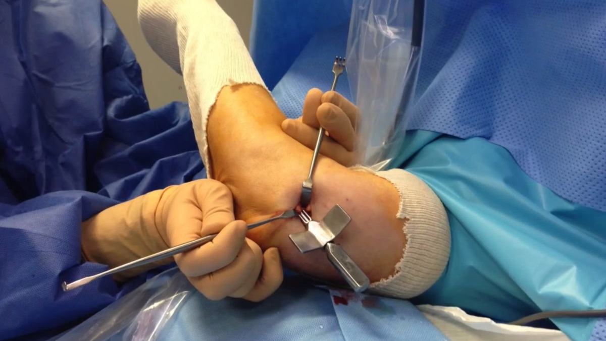 Elbow Surgery in Iran 