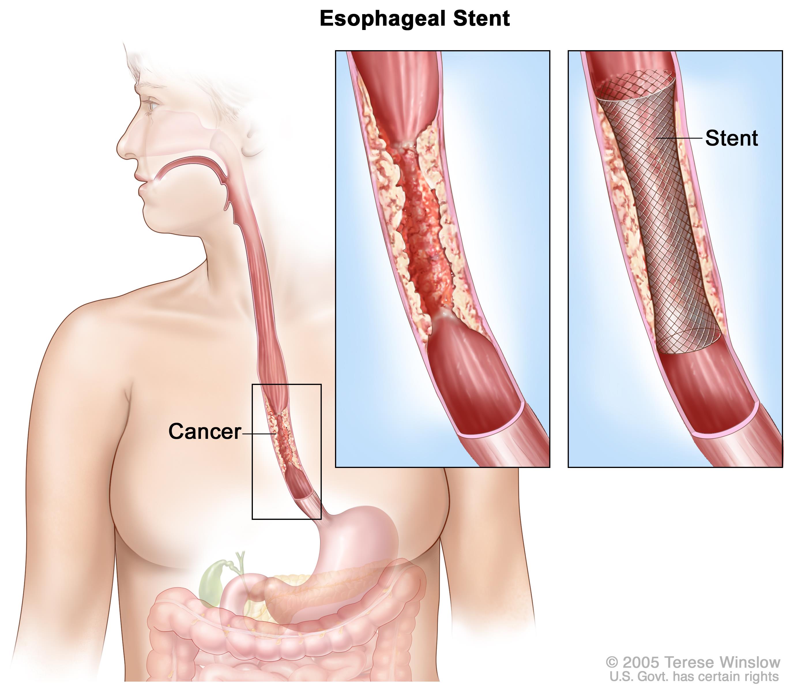 Esophageal Cancer Treatment in Iran
