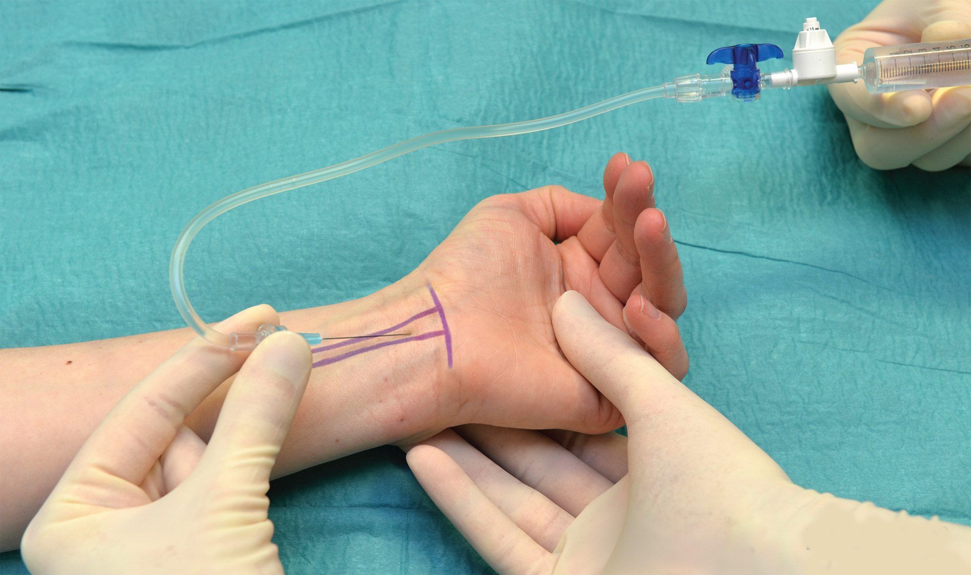 Hand and Wrist Surgery in Iran