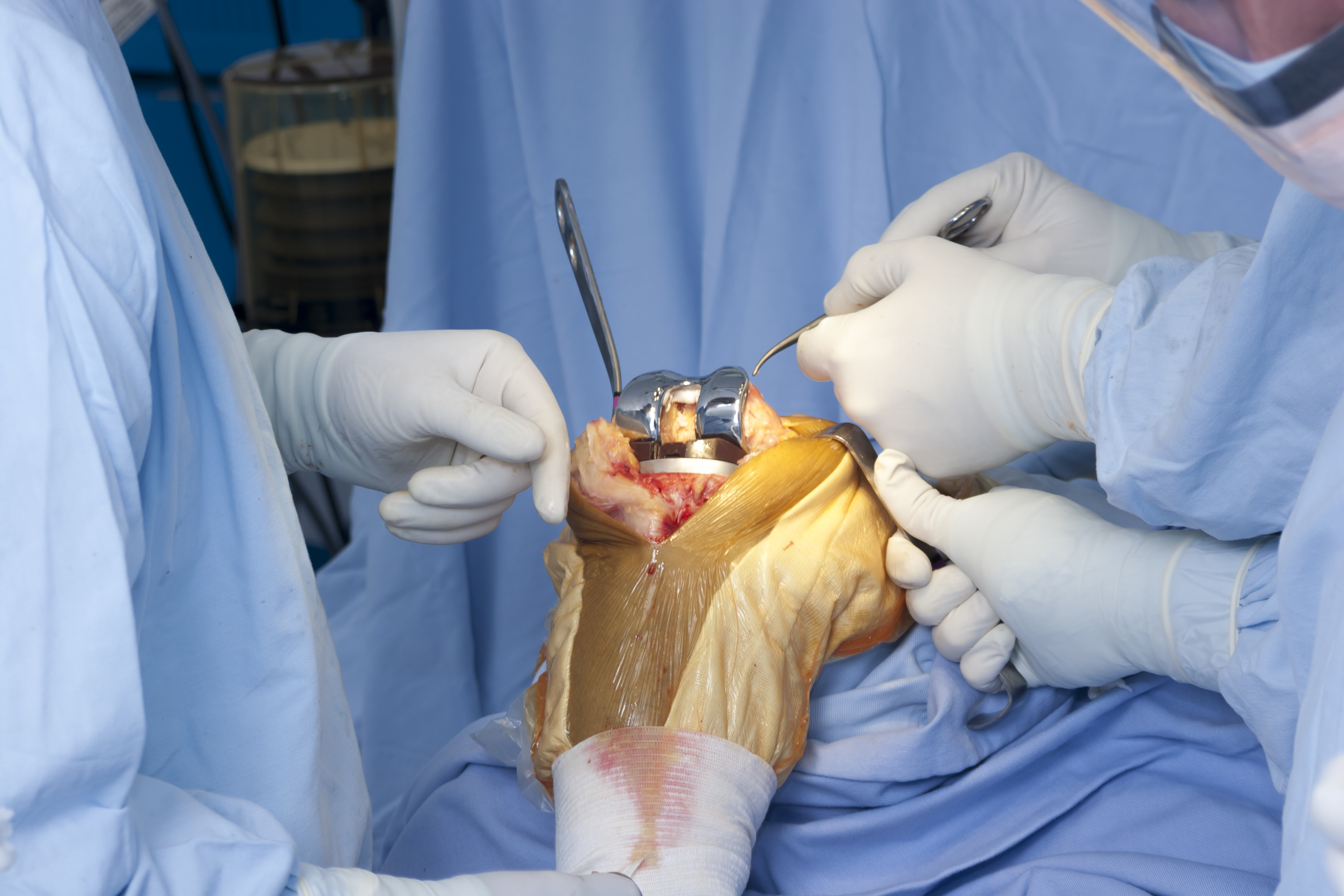 Knee Replacement Surgery in Iran