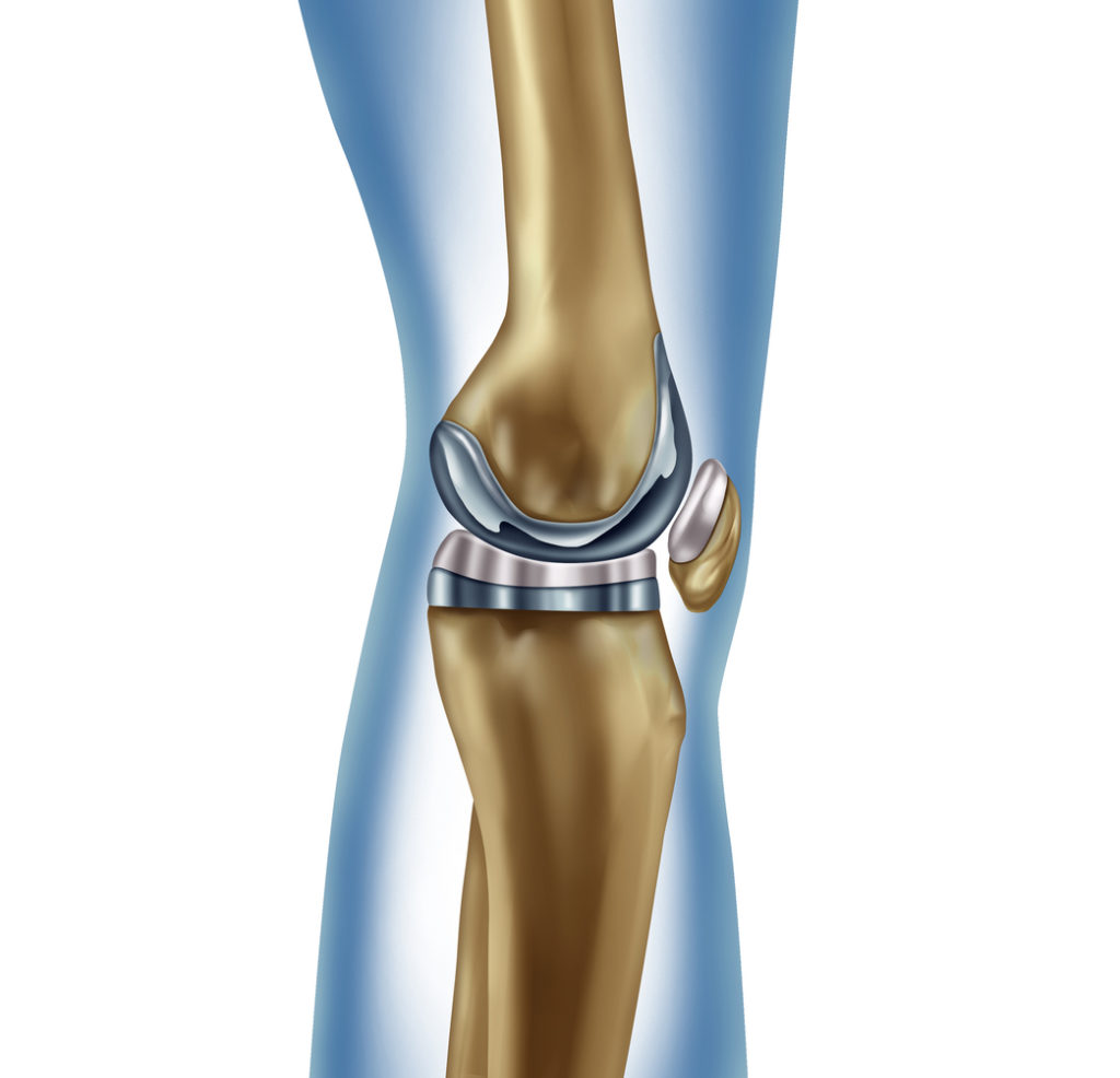 Knee Replacement Surgery in Iran 