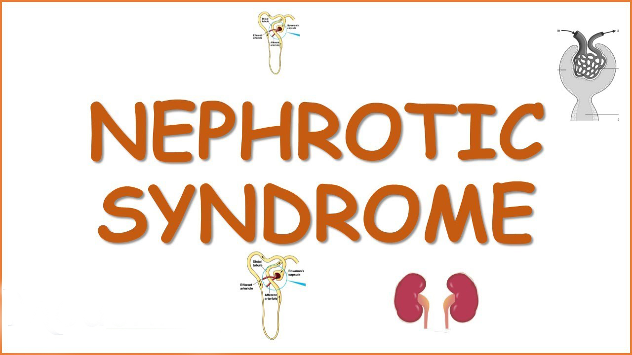 Nephrotic Syndrome Treatment in Iran 