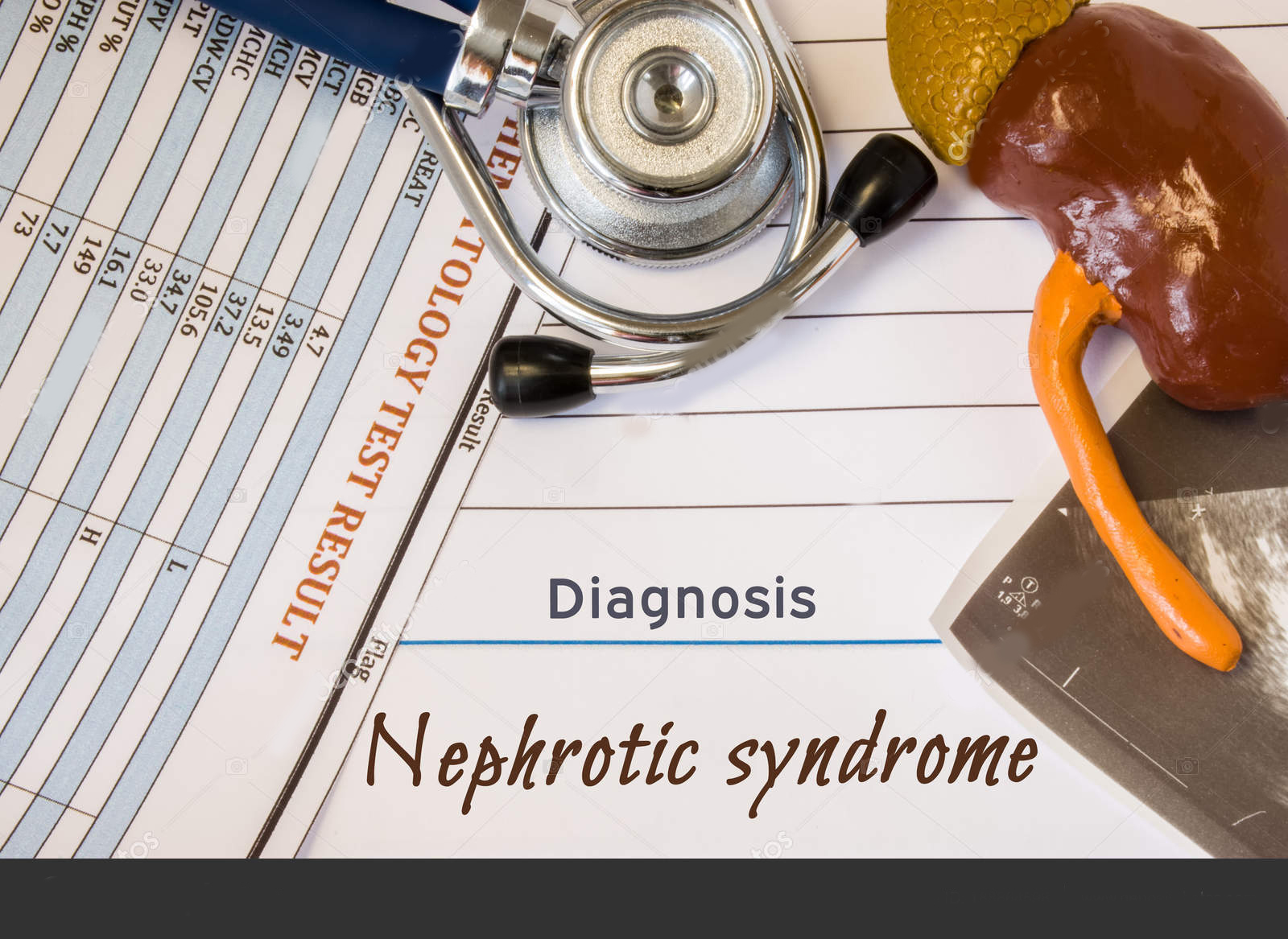 Nephrotic Syndrome Treatment in Iran