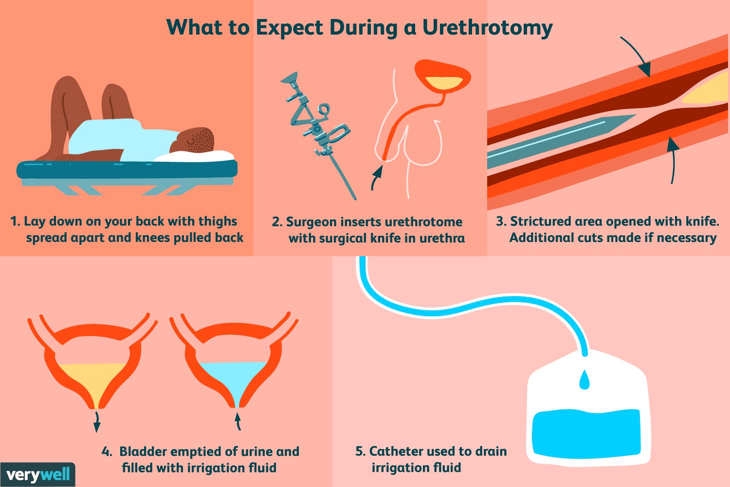 OIU-Optical Internal Urethrotomy in Iran 