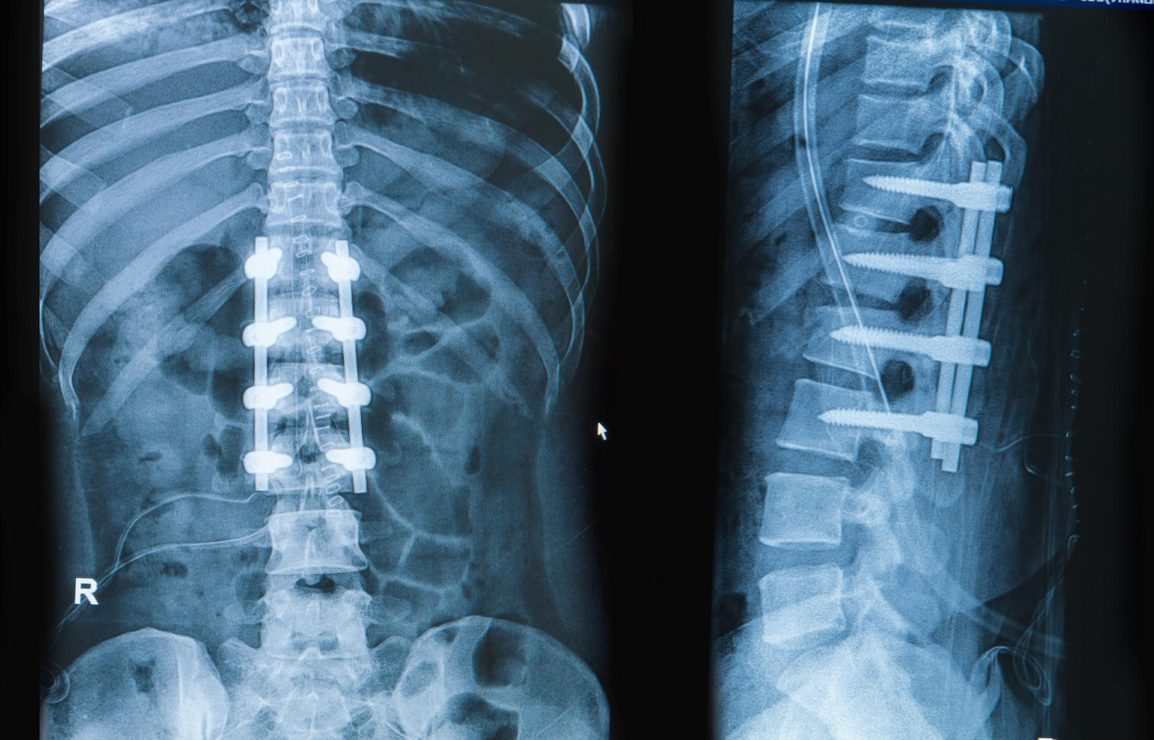 Spinal Fusion Surgery in Iran