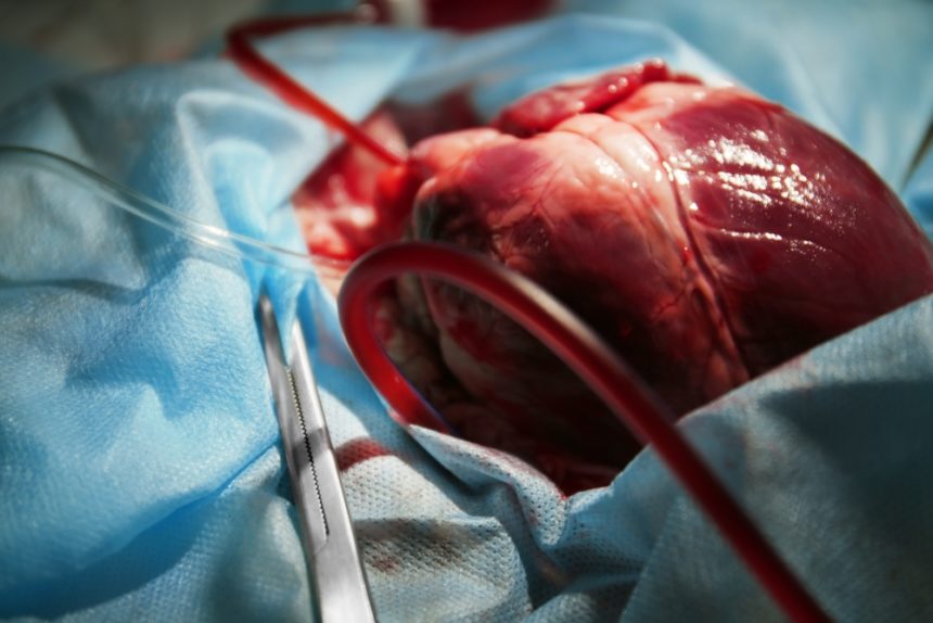 Heart Transplant in Iran 