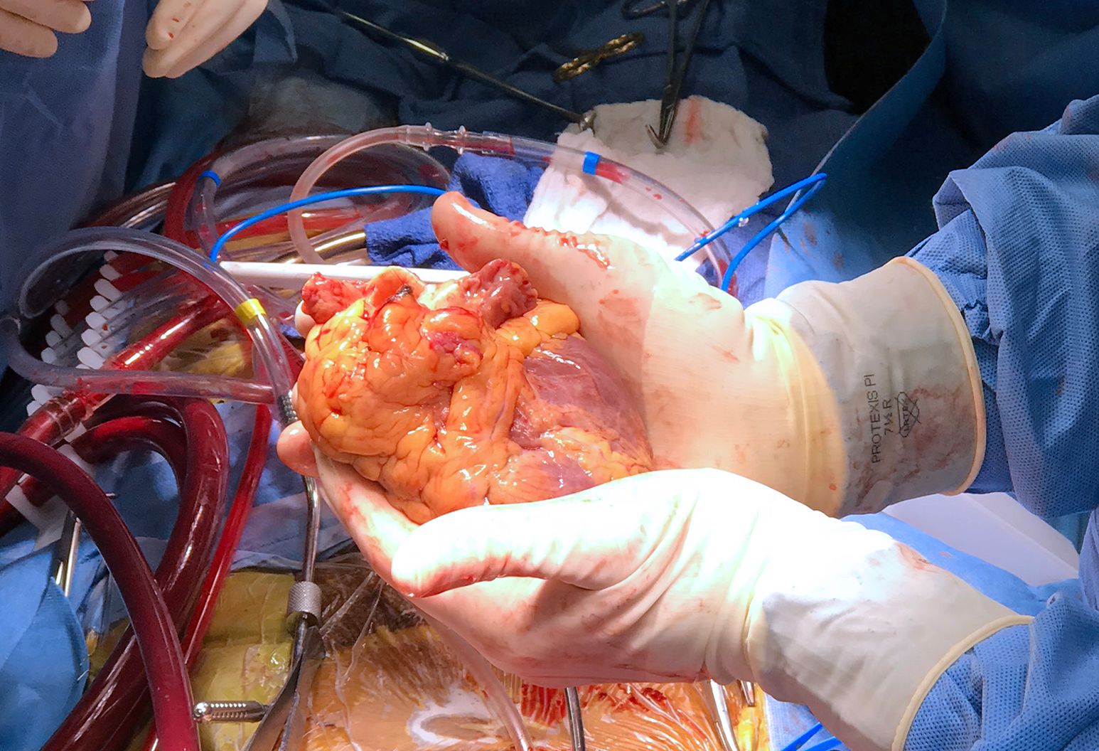 Heart Transplant in Iran
