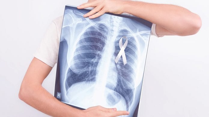 Lung Cancer Treatment in Iran 